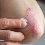 Plaque Psoriasis