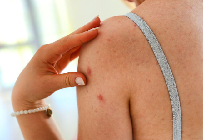 Back Acne