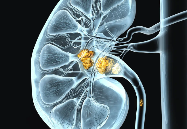 Kidney Stone