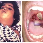 Diphtheria Diseases