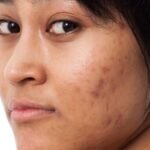 Home Remedies for Pigmentation