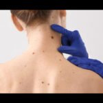 Skin Cancer Symptoms