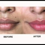 Home Remedies for Black Lips