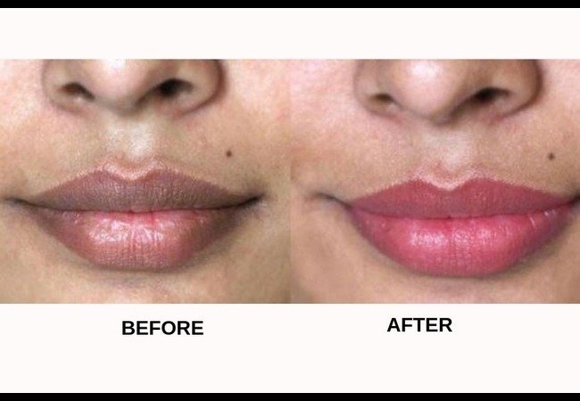 Home Remedies for Black Lips