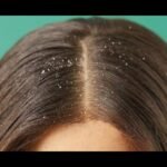 Home Remedies for Dandruff