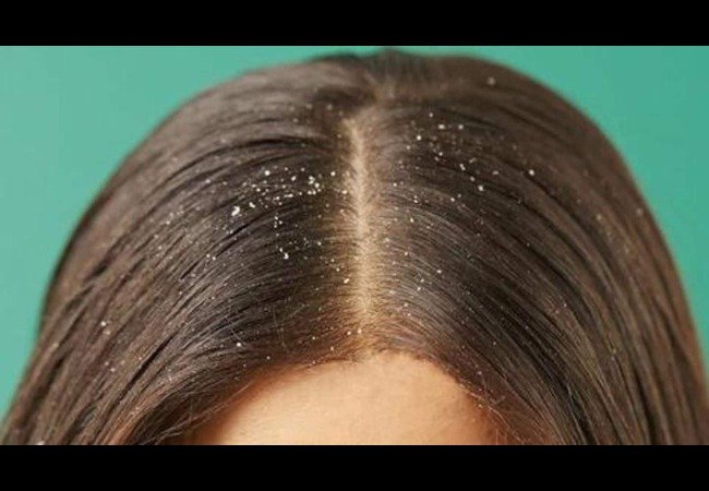 Home Remedies for Dandruff