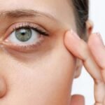 dark circles treatment