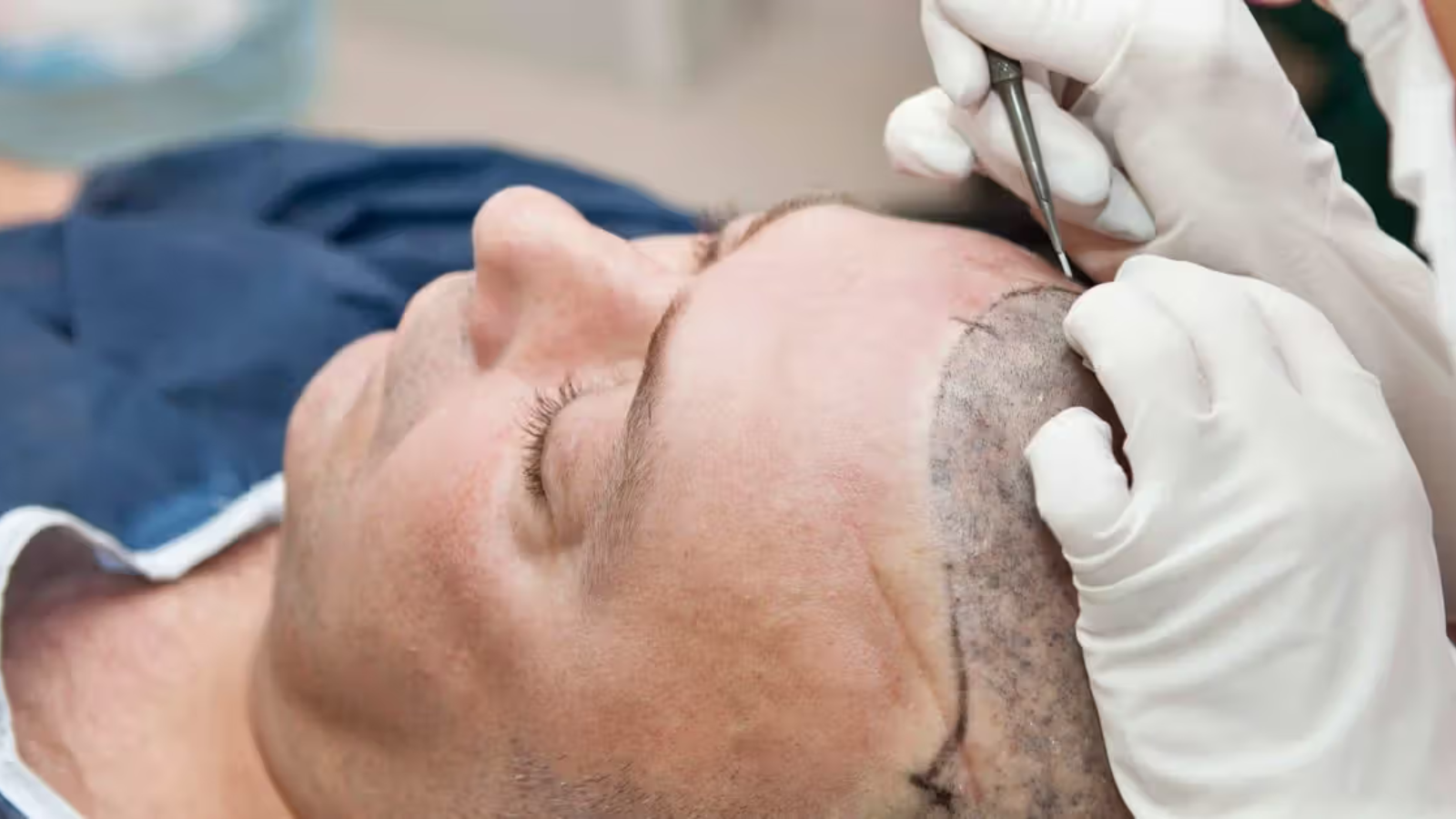 hair transplant tips