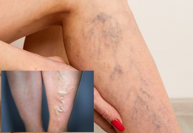 Varicose Veins