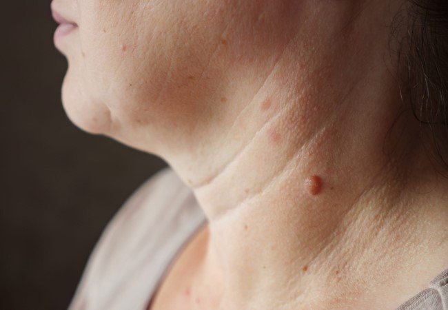 Warts | Latest Marathi News