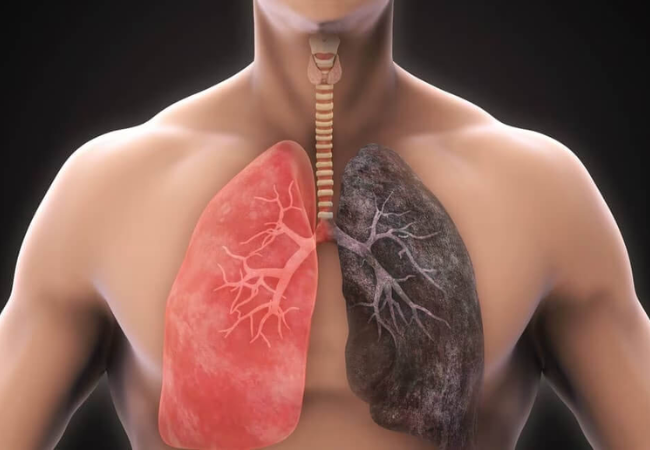 Chronic Lung Disease